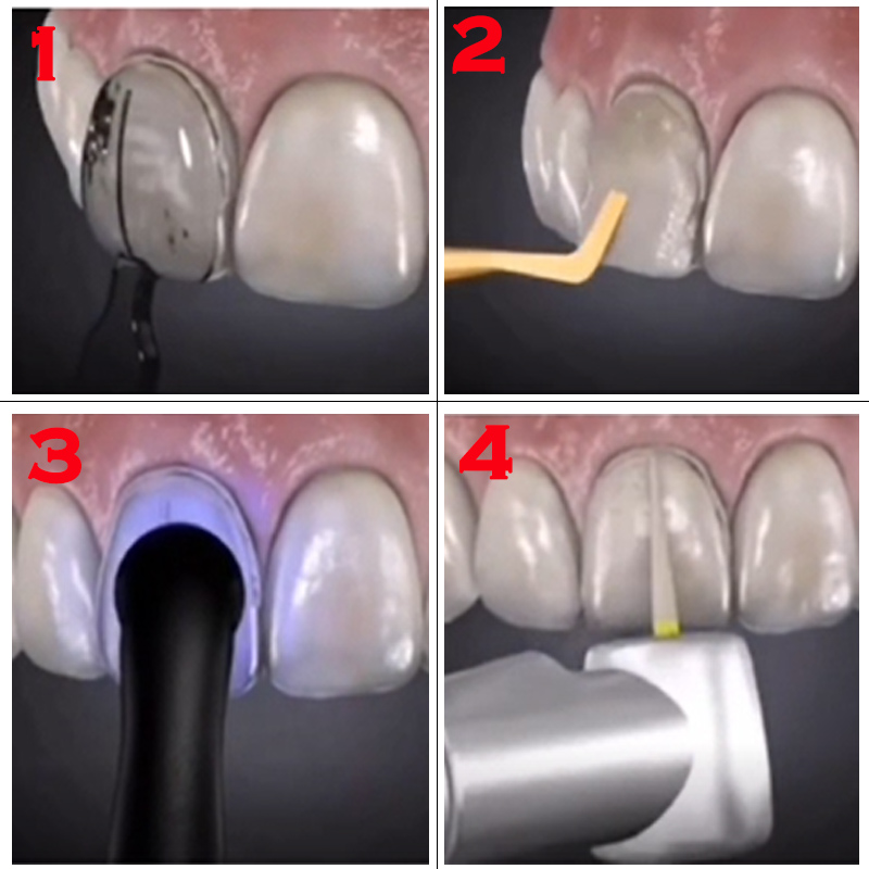 Kit de 32 Peças para Clareamen - Teeth Whitening Moulds avaliação e preço