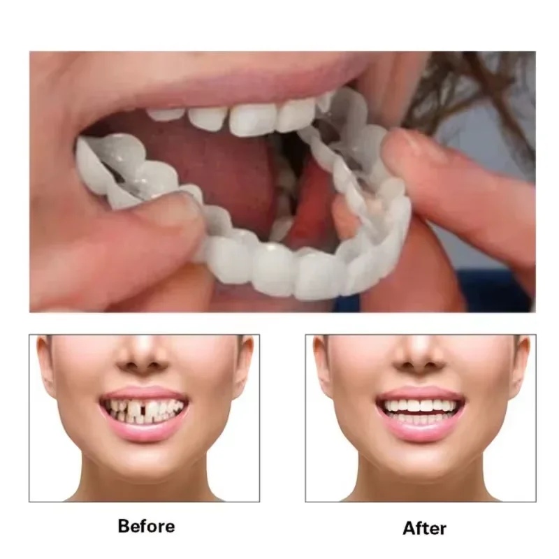 Kit de Dentes de Faceta Snap-o - Teeth Whitening Kit avaliação e preço